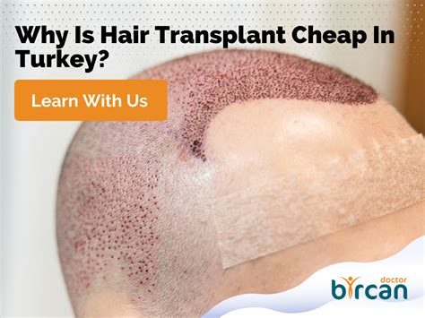 Why Is Hair Transplant Cheap In Turkey Dr Gökhan Bircan