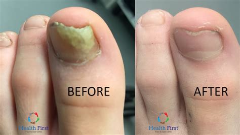 How To Cure Fungal Toenails Onychomycosis Health First Foot And