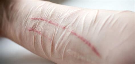 Self Harm Patients Need Further Intervention After Discharge