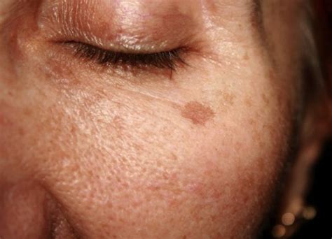 Age Spots Finesse Skin Clinic