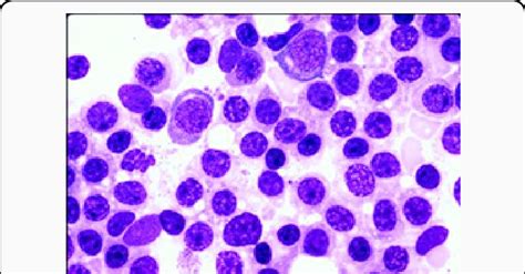 Lpl Disseminated Small Mature Lymphocytes And Plasmacytoid Cells