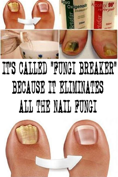 Its Called Fungi Breaker Because It Eliminates All The Nail Fungi