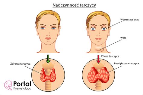 Nadczynno Tarczycy Portal Kosmetologa