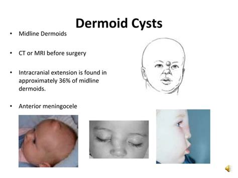 Dermoid And Epidermoid Cysts
