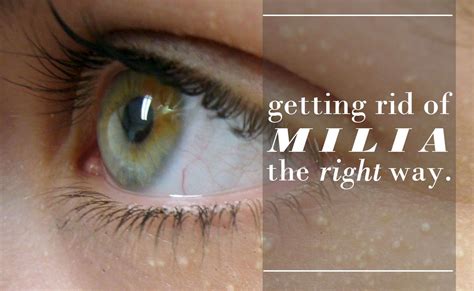 The One Thing You Really Need To Know About Treating Milia Those Small