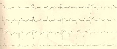 Stemi Case Examples Wikidoc
