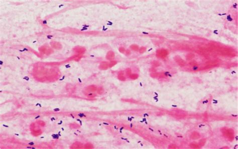 Corynebacteria As A Cause Of Pulmonary Infection A Case