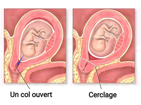 Cerclage du col de l utérus pendant la grossesse