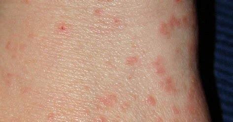 Penyebab munculnya bintik merah pada kulit yang disertai gatal. DanaPedia 博客: Gatal-gatal bintik air bening dan merah di ...