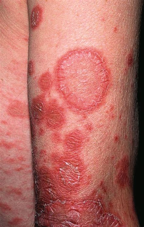 Inhalation Route Inducing Subacute Cutaneous Lupus Erythematosus With