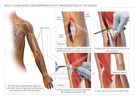 Ulnar Nerve Decompression With Transposition High Impact Llc