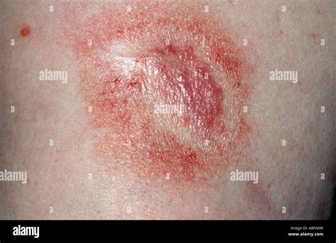 Marked Skin Reaction Dithrocream Erythema Hi Res Stock Photography And