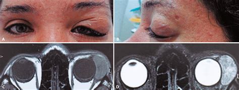 Scielo Brasil Solitary Fibrous Tumor Of The Lacrimal Gland