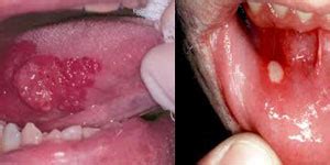 Treatment of mouth cancer depends on the location and stage of cancer. Avdhoot Dental & Implant