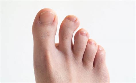 Lesser Toe Surgery Yeg Foot And Ankle Inc