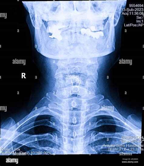 Human Cervical Spine X Ray Neck Radiography Stock Photo Alamy