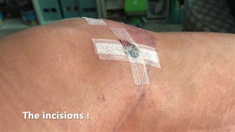 11 how to sleep after meniscus repair. TWO DAYS AFTER TORN MENISCUS SURGERY vlog#11 5 19 18 - YouTube