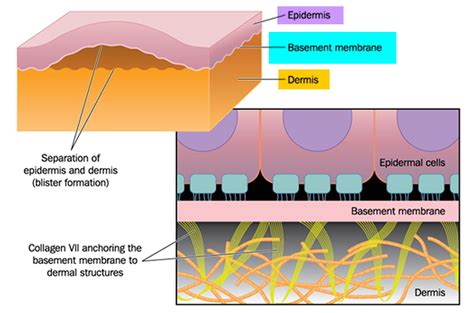 Epidermolysis Bullosa Causes Symptoms Types Prognosis And Treatment