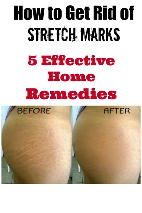 Redirecting Stretch Marks Stretch Mark Remedies Stretch Marks On Thighs