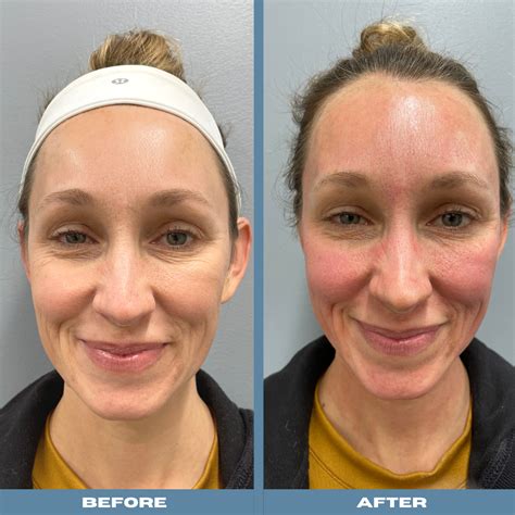 My Microneedling Real Life Before And After Experience Cornerstone Dermatology Surgery Group