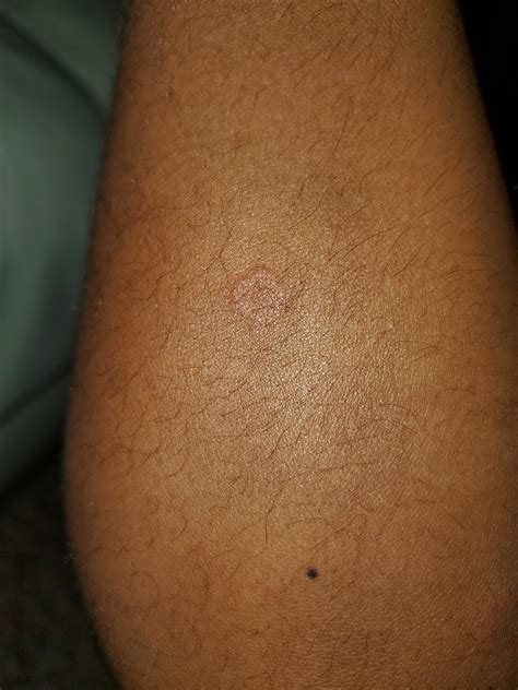 Can Anyone Help Me Identify This Rash It Seems To Be Spreading On My
