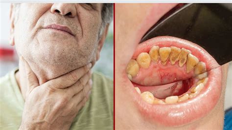 Early Warning Signs Of Oral Cancer