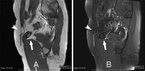 Radiographic And Surgical Findings Of Type I Obturator Hernias In