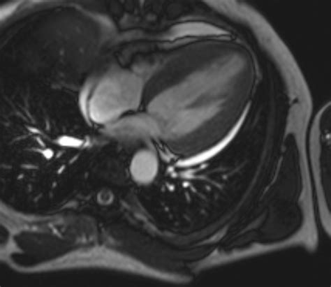 Left Ventricular Hypertrophy Cardiac Mri Sumers Radiology Blog