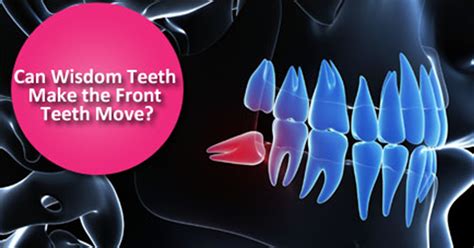 Can Wisdom Teeth Cause Teeth Crowding