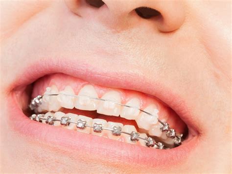 frenillo lingual y labial y la ortodoncia dra sara gil ortodoncista