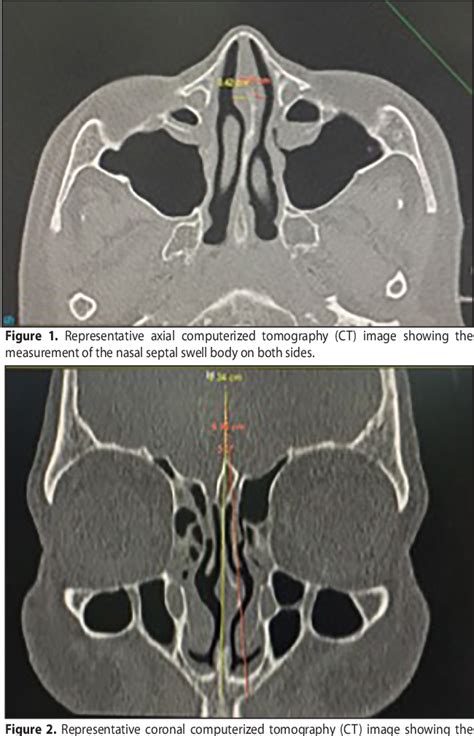 Pdf Radiologic Study Of The Nasal Septal Swell Body And Its Relationship To Septal Deviation