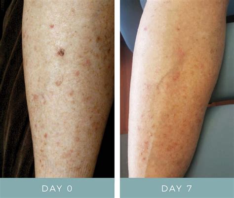 Before After Chemotherapy Rash 1 Neogenesis