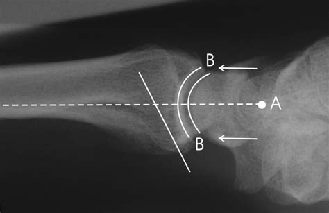 Radiographic Parameters Of Distal Radius Fractures Musculoskeletal Key