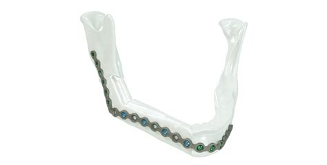 Kls Martin Ips Implants® Mandible Reconstruction