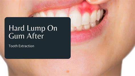 Hard Lump On Gum After Tooth Extraction What You Should Do