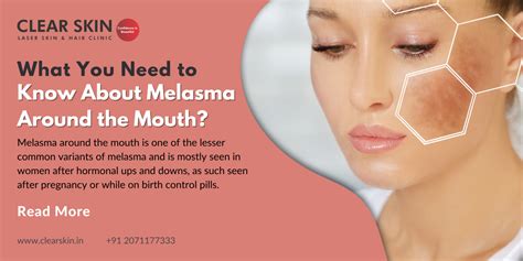 What You Need To Know About Melasma Around The Mouth