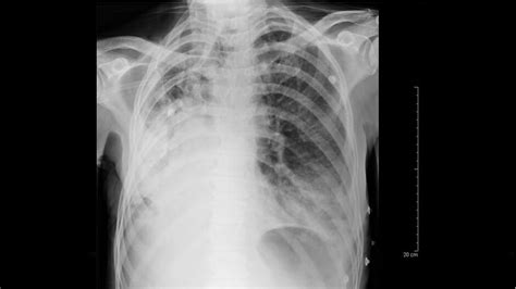 Hospital Acquired Pneumonia Clinical And Radiological Features Onthewards