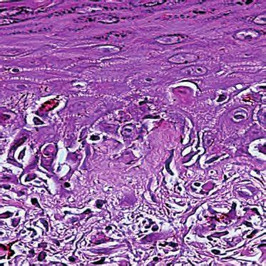 Histological Aspects Of Cutaneous Gvhd Skin Biopsy Of Cutaneous Gvhd Download Scientific