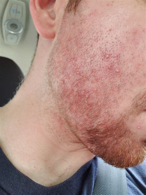 Do These Look Like Rosacea Putules Or Acne Rosacea