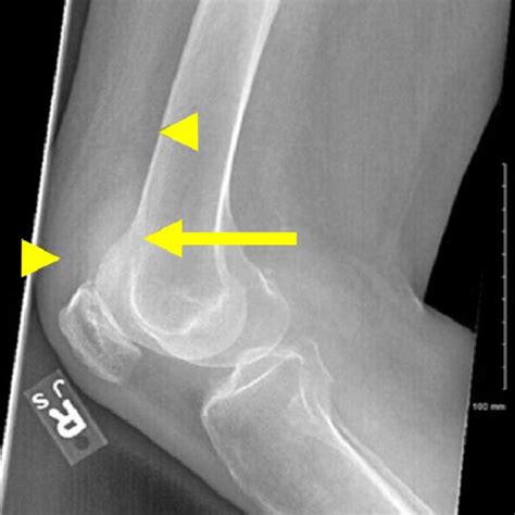 Right Lateral Knee Radiograph The Joint Effusion Arrow Can Be Most