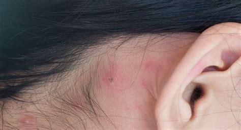 Heres How You Can Treat Pimples Behind The Ears