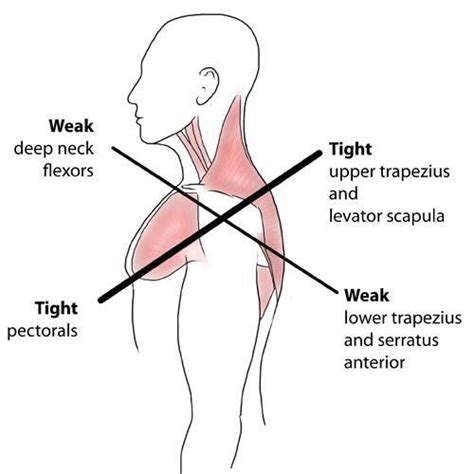 How To Treat Upper Crossed Syndrome Or Forward Head Posture