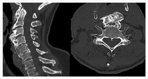 Patient Computed Tomography CT Cervical Spine Sagittal Left And Download Scientific