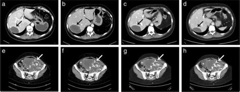 Contrast Enhanced Ct Scan Of The Liver And The Pelvis Axial Plane