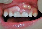 Gum Line Cavity Treatment Photos