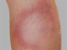 Lyme disease rash: Symptoms, stages, and identification
