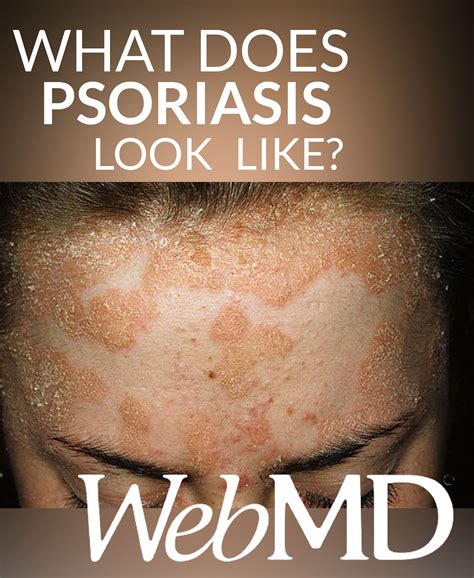 Pin On All About Psoriasis