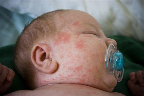 Red Rash On Neck Babyandbump