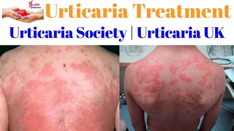 Urticaria Treatment Urticaria Society Urticaria Uk 😉 Youtube