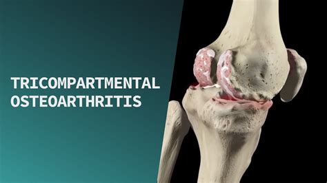 Tricompartmental Osteoarthritis Youtube